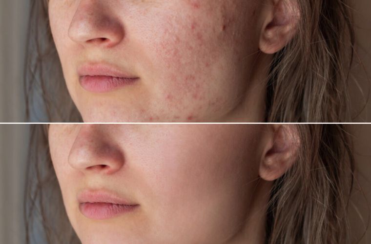 Acne scarring and texture, cheek, before and after at Skin&Co Mississauga