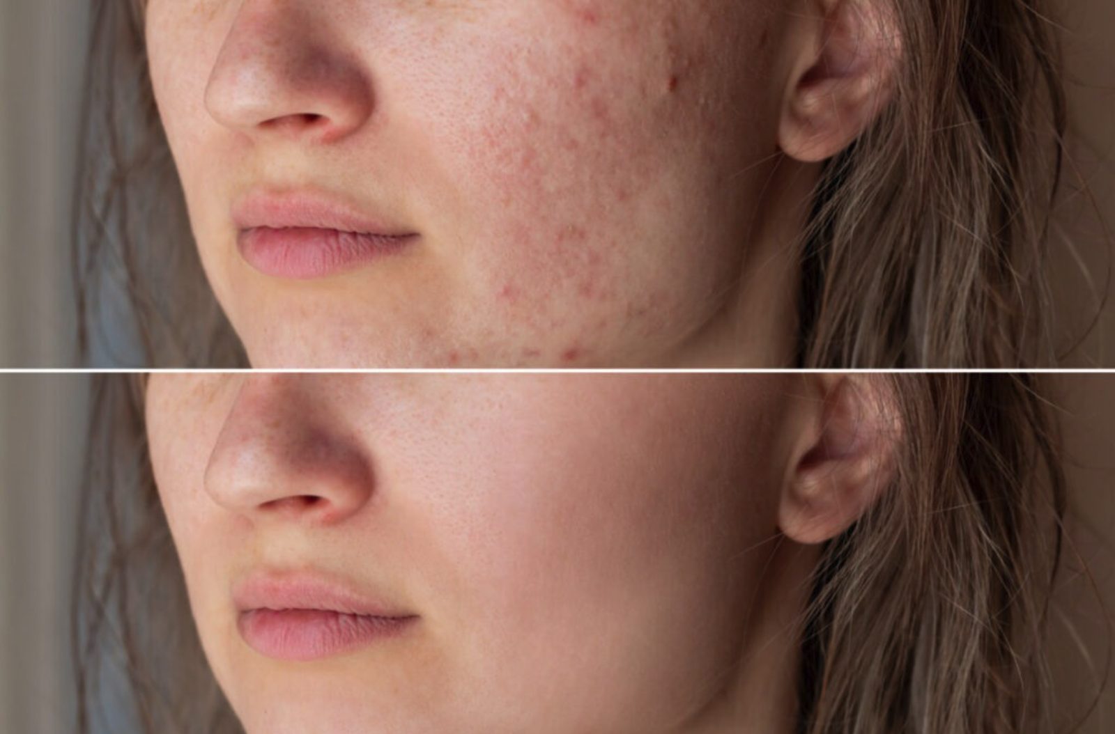 Acne scarring and texture, cheek, before and after at Skin&Co Mississauga