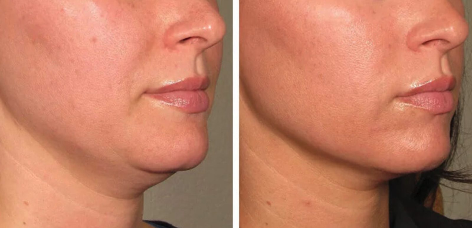 Jawline and lower face laxity, before and after at Skin&Co Mississauga