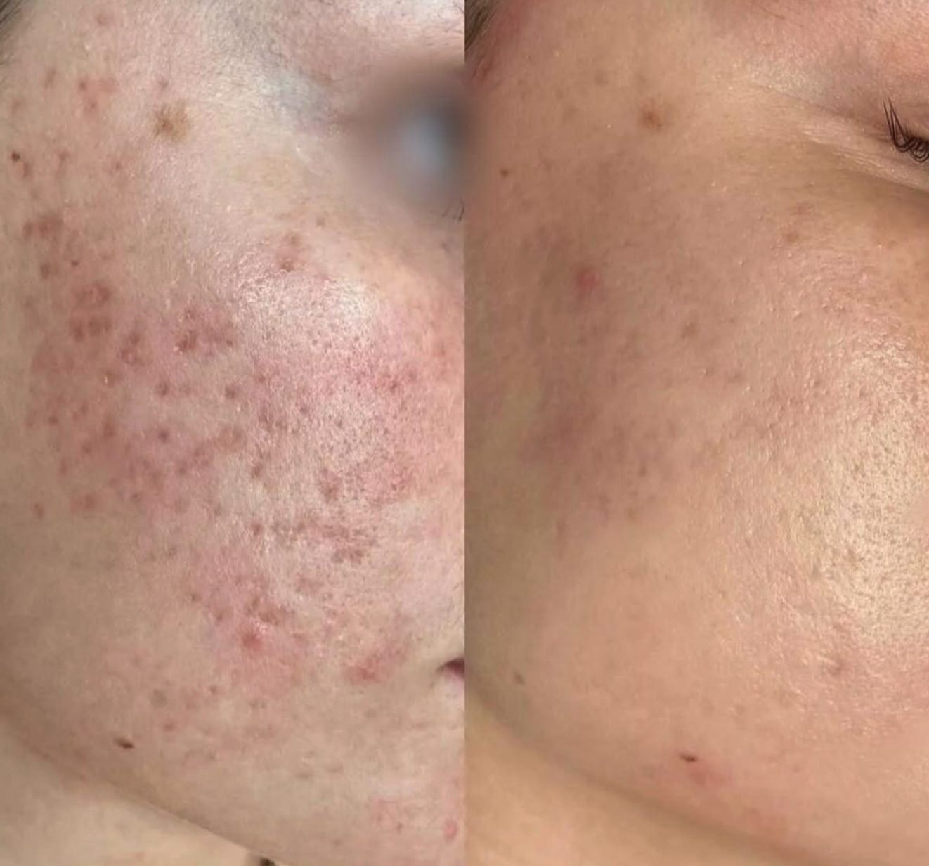 Active acne and marks, before and after at Skin&Co Mississauga