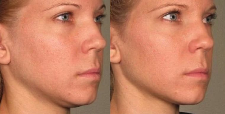 Overall skin tone and clarity, before and after at Skin&Co Mississauga