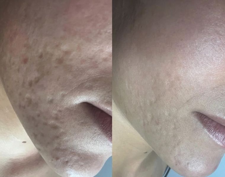 Enlarged pores, nose and cheek, before and after at Skin&Co Mississauga