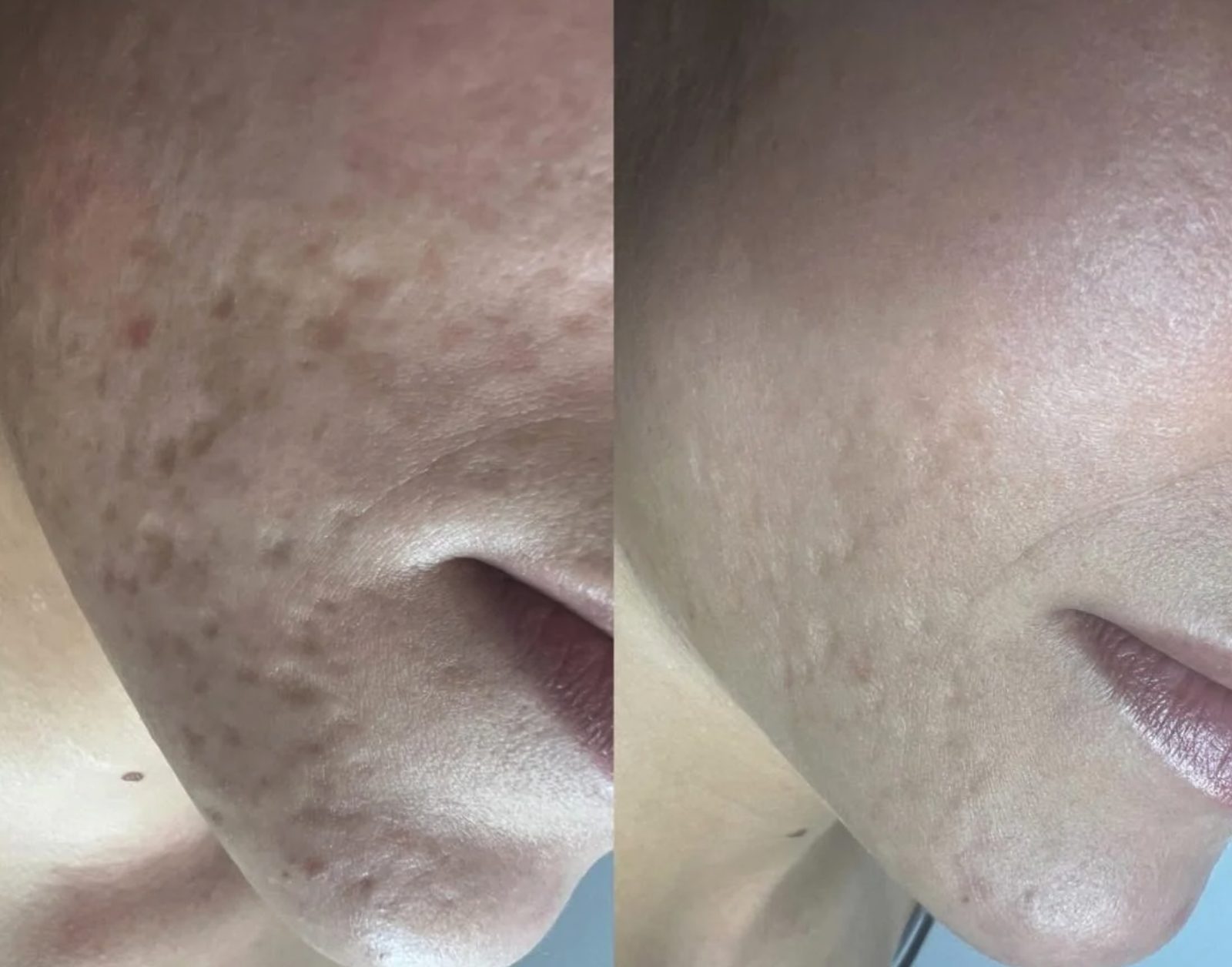 Enlarged pores, nose and cheek, before and after at Skin&Co Mississauga