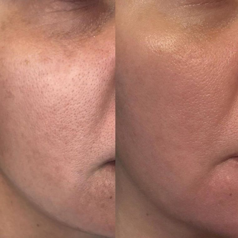 Skin texture and pore size, cheek, before and after at Skin&Co Mississauga