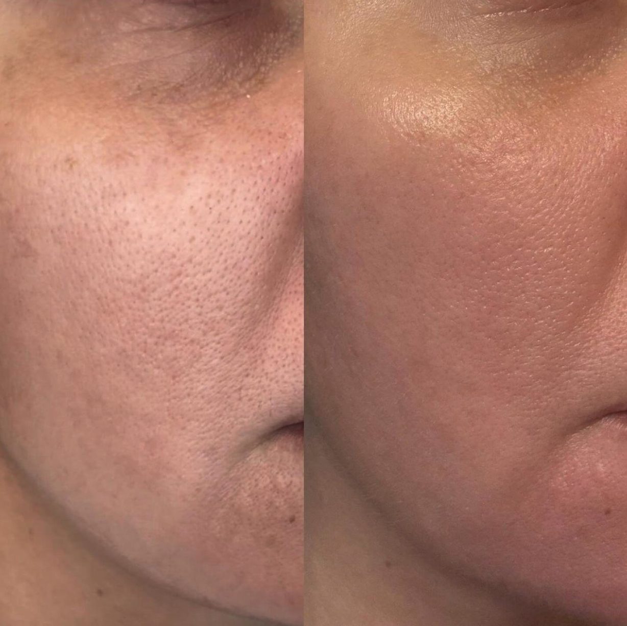 Skin texture and pore size, cheek, before and after at Skin&Co Mississauga