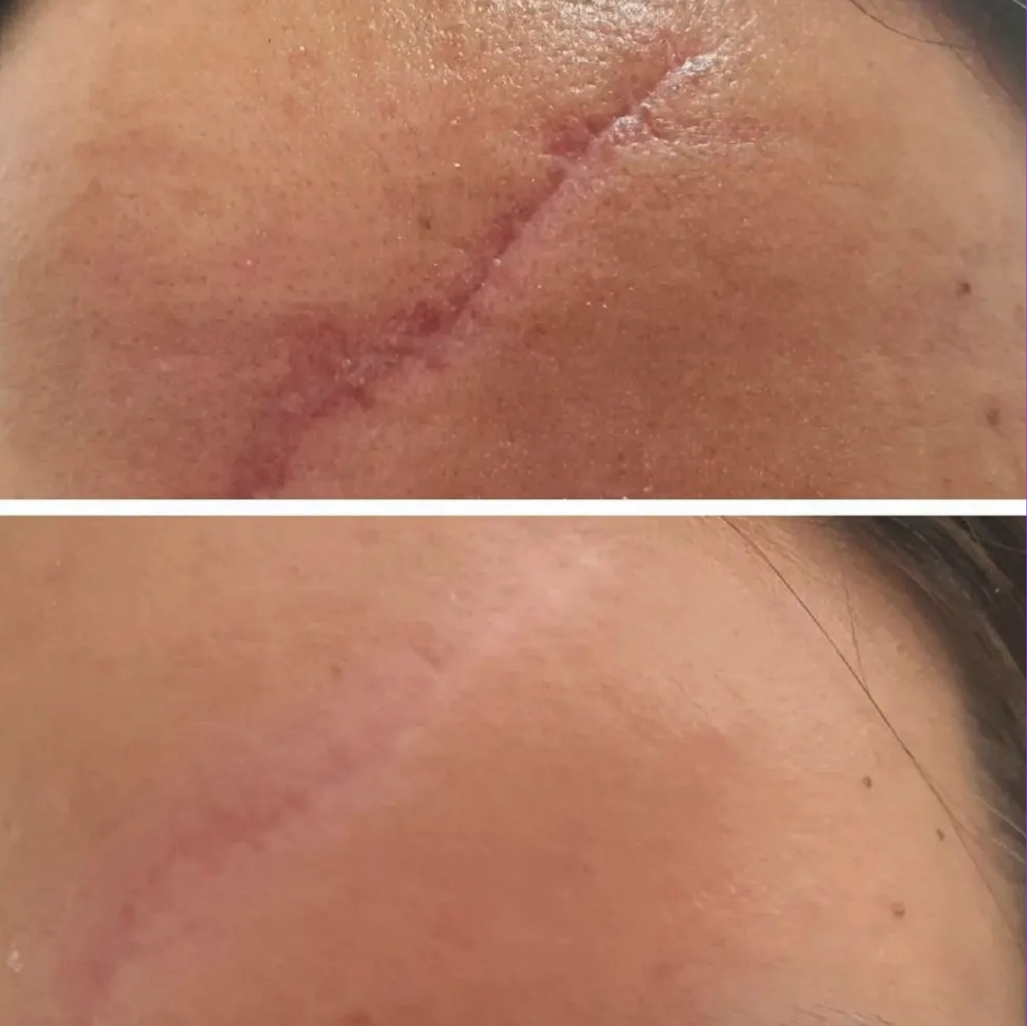 Raised scar, softened and flattened, before and after at Skin&Co Mississauga