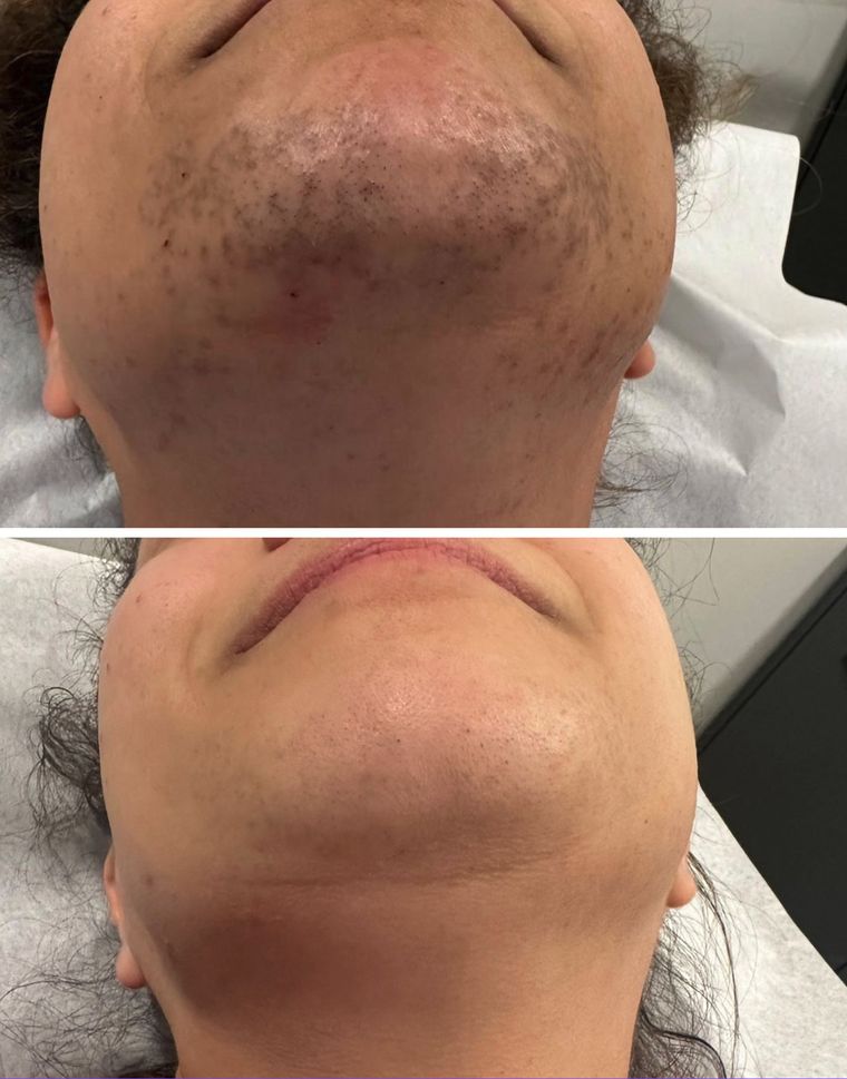 Submental fullness under the chin, before and after at Skin&Co Mississauga