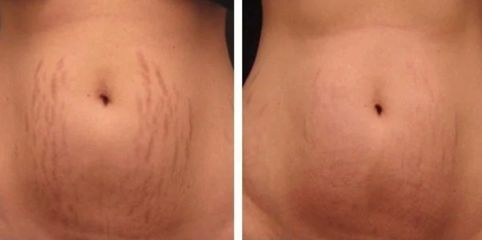 Stretch marks and skin texture, before and after at Skin&Co Mississauga