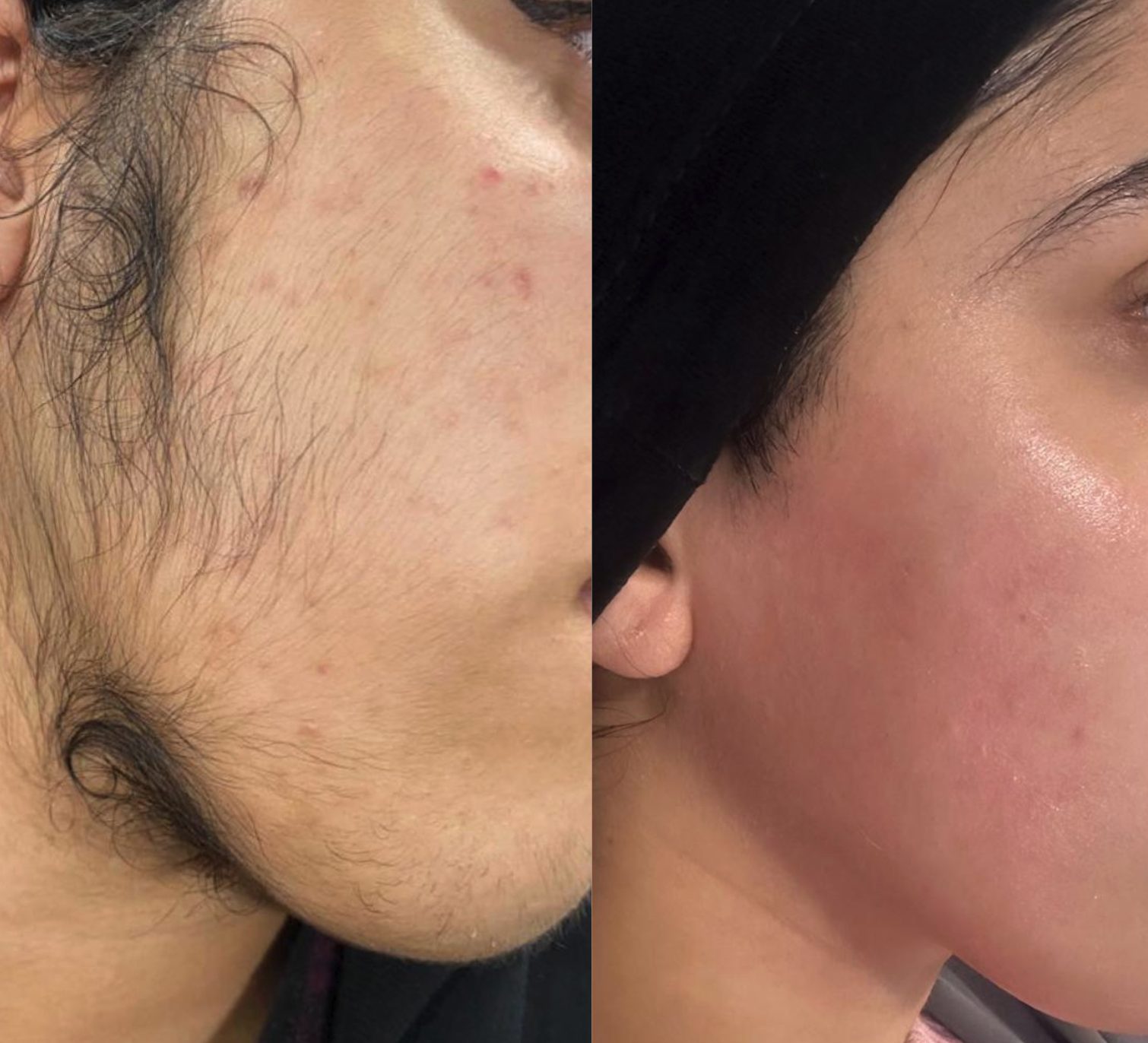 Unwanted facial hair, jaw and chin, before and after at Skin&Co Mississauga