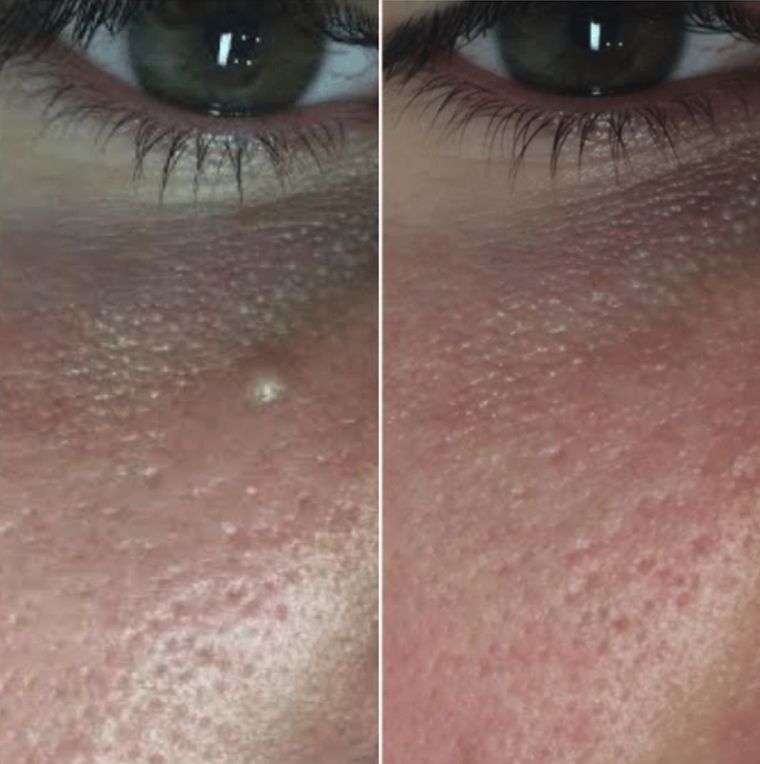 Congestion and texture under the eye, before and after at Skin&Co Mississauga