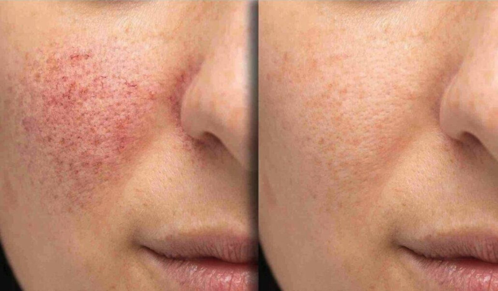 Facial redness and visible vessels, before and after at Skin&Co Mississauga