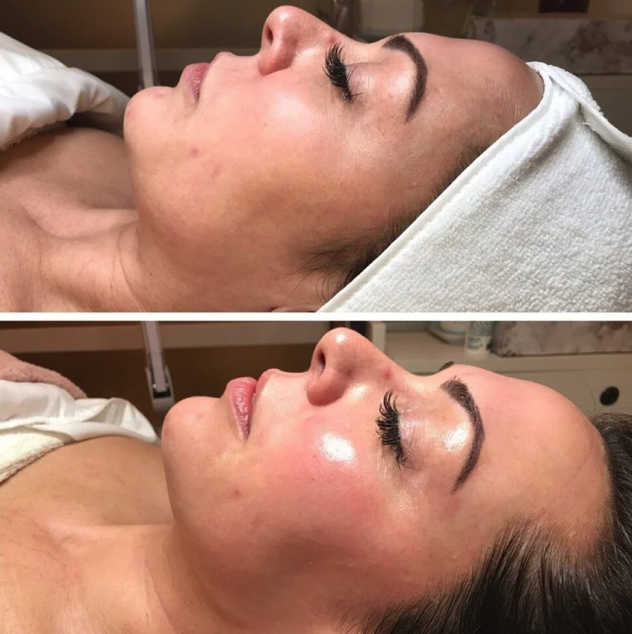 Skin clarity and hydration after a facial, before and after at Skin&Co Mississauga