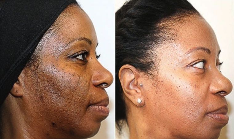 Melasma on deeper skin, before and after at Skin&Co Mississauga