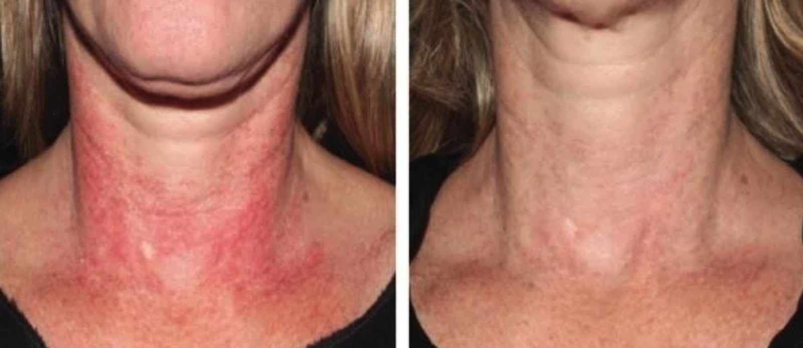 Redness across the neck and chest, before and after at Skin&Co Mississauga