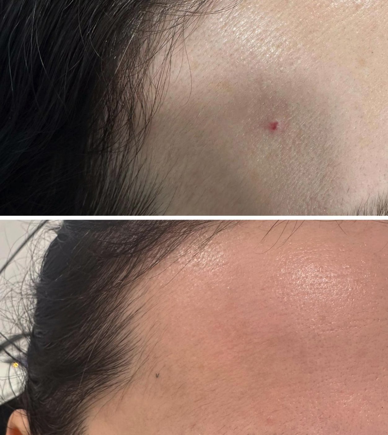 Raised lesion on the forehead, before and after at Skin&Co Mississauga