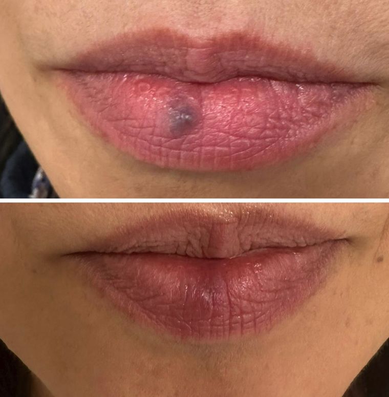 Vascular lesion on the lip, before and after at Skin&Co Mississauga