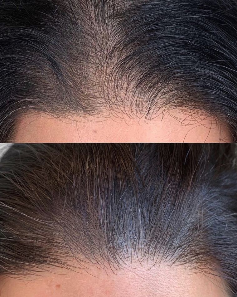 Hair density along the hairline, before and after at Skin&Co Mississauga