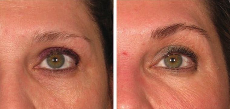 Under eye hollowing, before and after at Skin&Co Mississauga