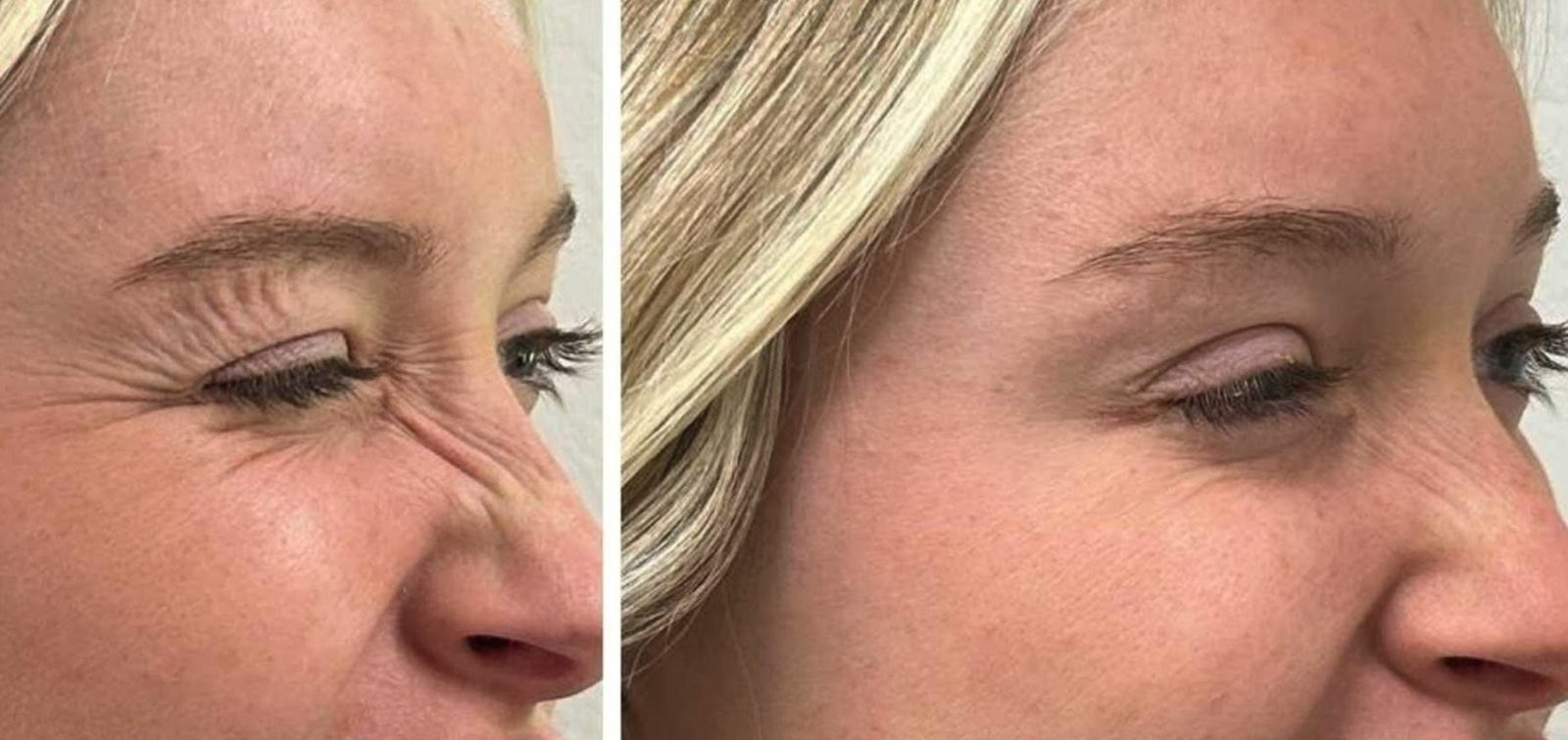 Lines at the outer eye, before and after at Skin&Co Mississauga