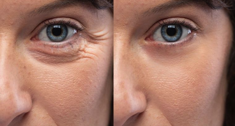 Tear trough and under eye shadow, before and after at Skin&Co Mississauga