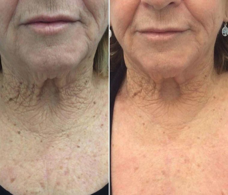 Deep perioral and neck lines, before and after at Skin&Co Mississauga