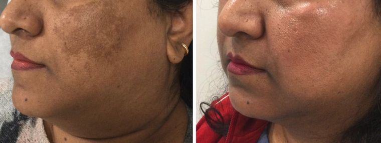 Melasma across the cheek and jaw, before and after at Skin&Co Mississauga