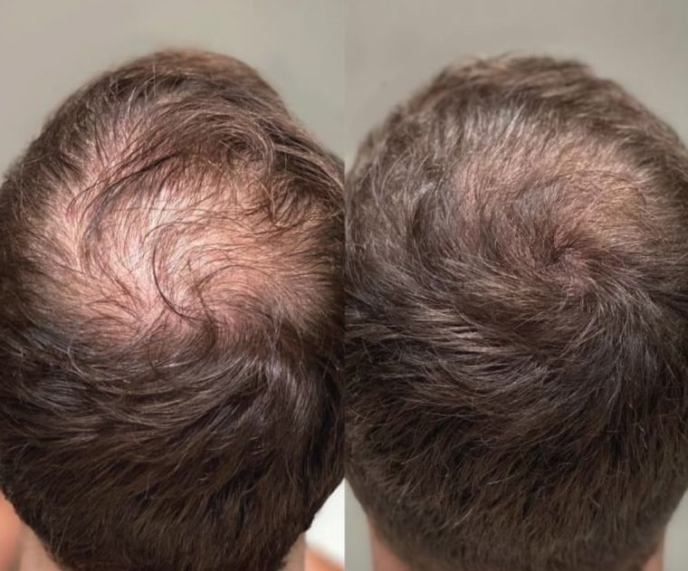 Hair regrowth across the crown, before and after at Skin&Co Mississauga