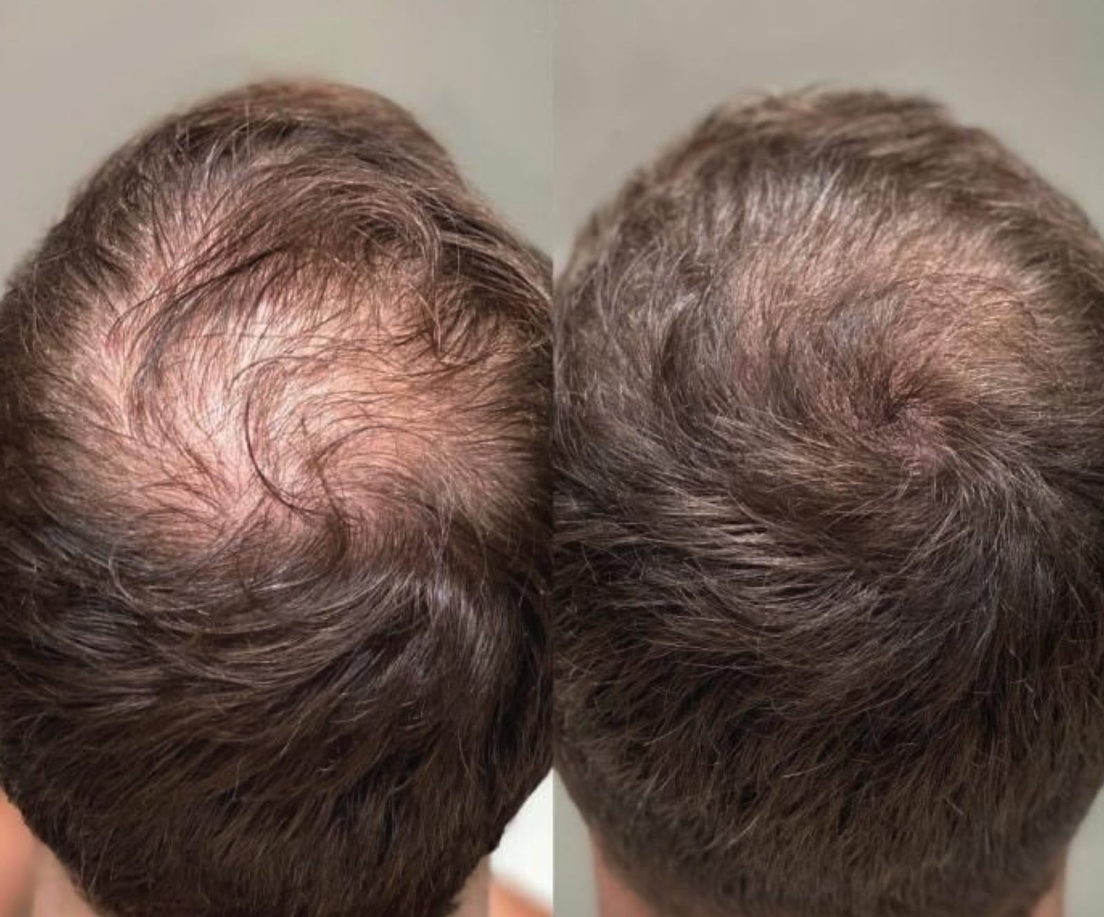 Hair regrowth across the crown, before and after at Skin&Co Mississauga