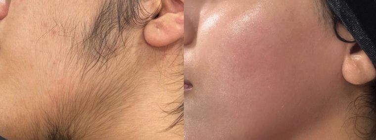 Unwanted hair, sideburn and cheek, before and after at Skin&Co Mississauga