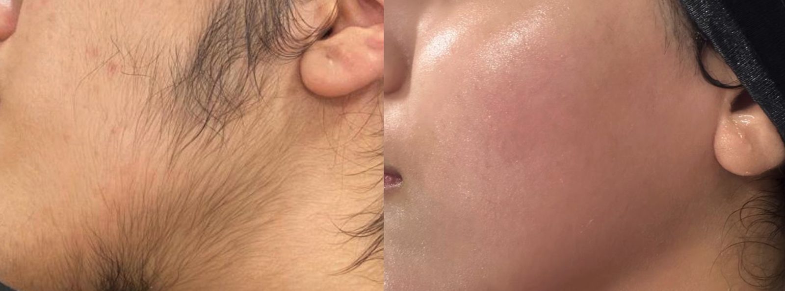 Unwanted hair, sideburn and cheek, before and after at Skin&Co Mississauga