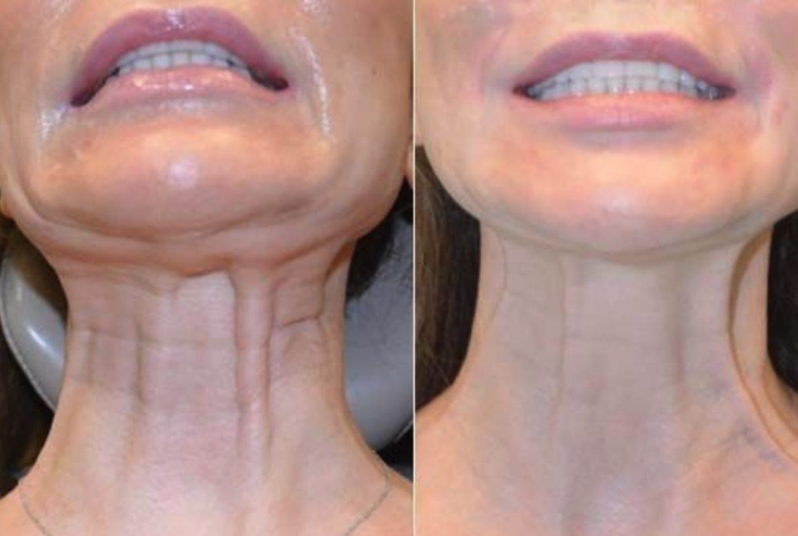 Neck laxity and jawline definition, before and after at Skin&Co Mississauga