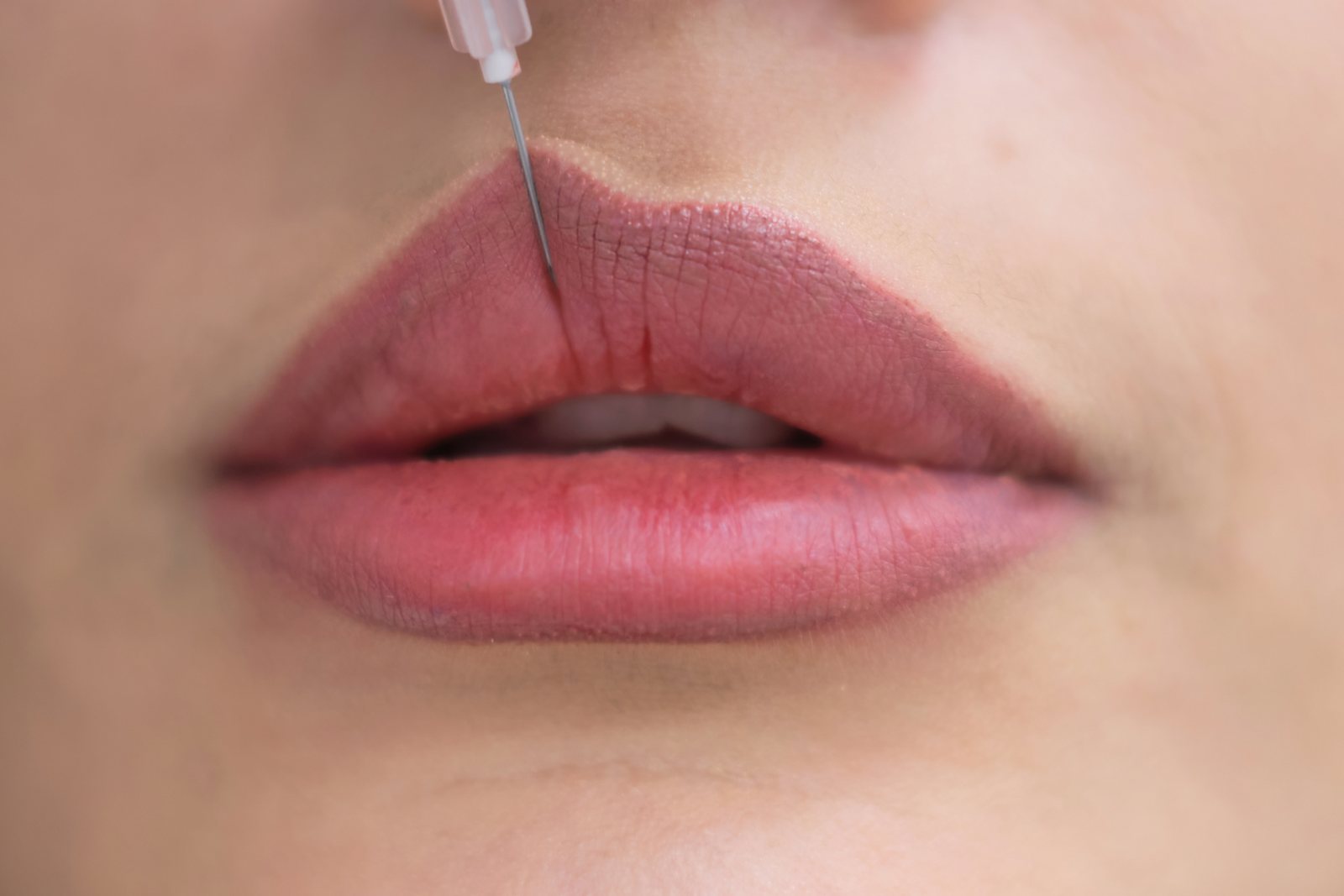 Dermal Fillers treatment at Skin&Co, Mississauga