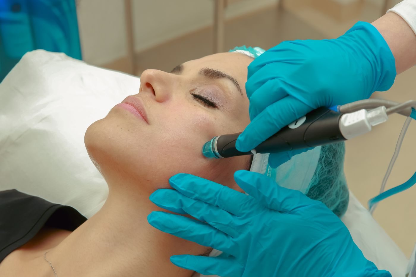 Concerns treated by microdermabrasion in Mississauga