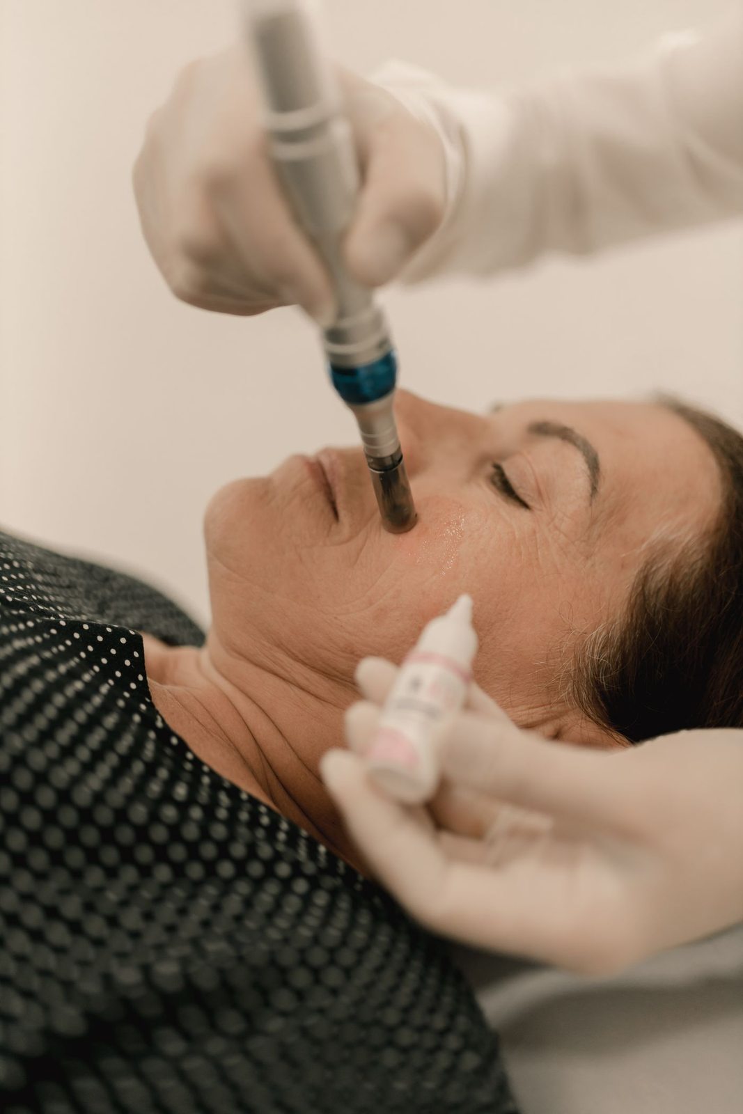 Microneedling in Mississauga, step 3: treatment