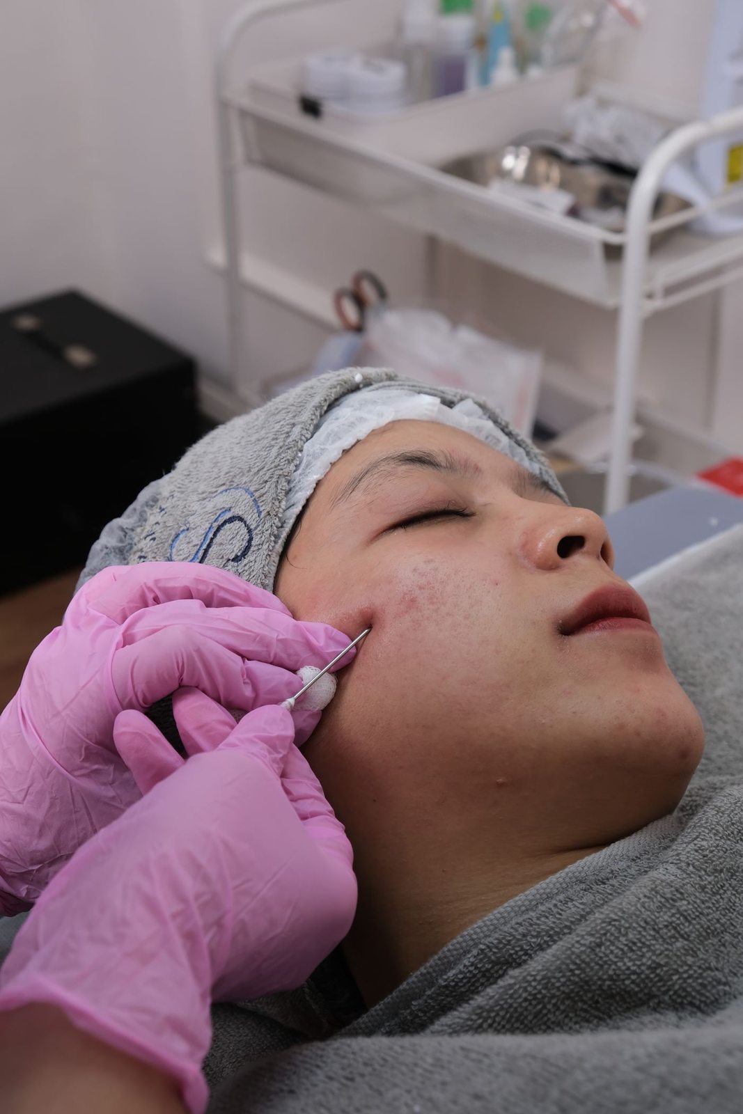 Micropen in Mississauga, step 3: treatment