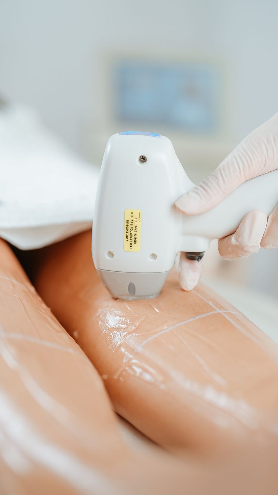 Alexandrite Laser in Mississauga, step 3: treatment