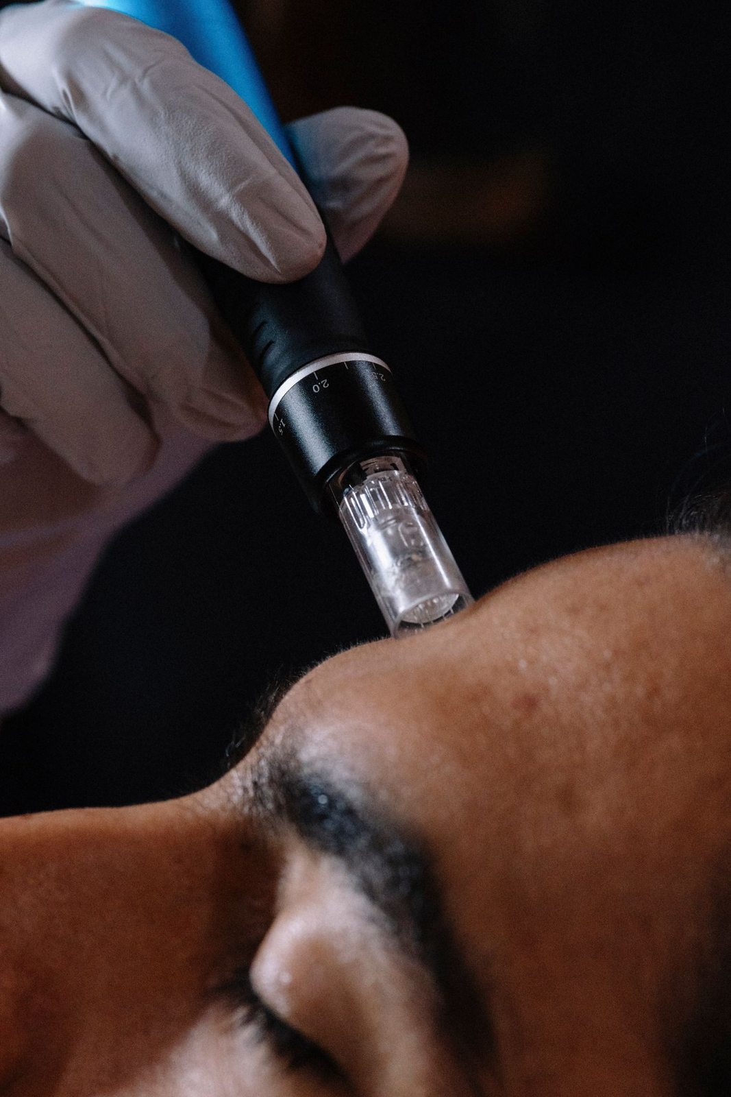 CO2 Laser Resurfacing in Mississauga, step 1: consultation and skin typing