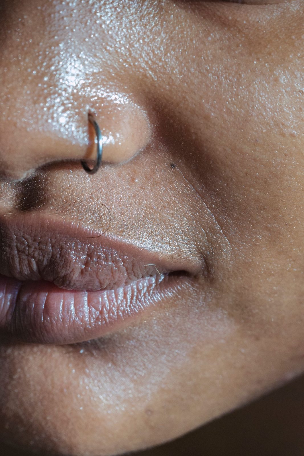 Alexandrite Laser in Mississauga, step 1: skin typing and diagnosis