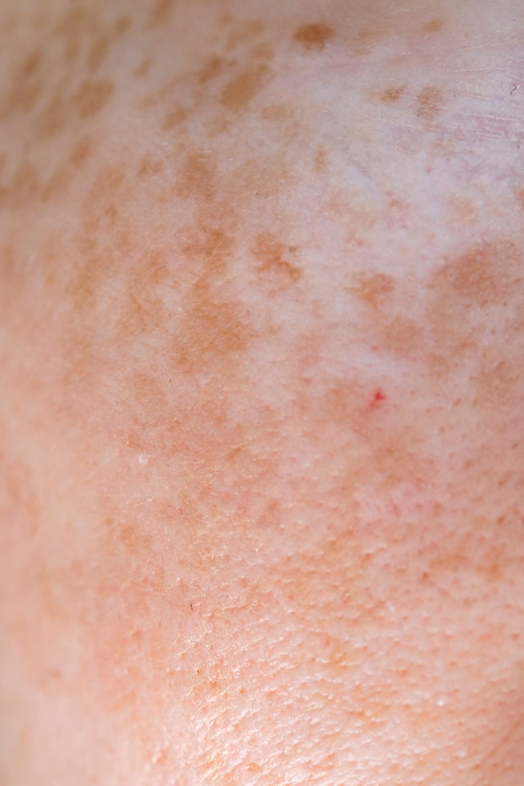 Concerns treated by pulse dye laser in Mississauga