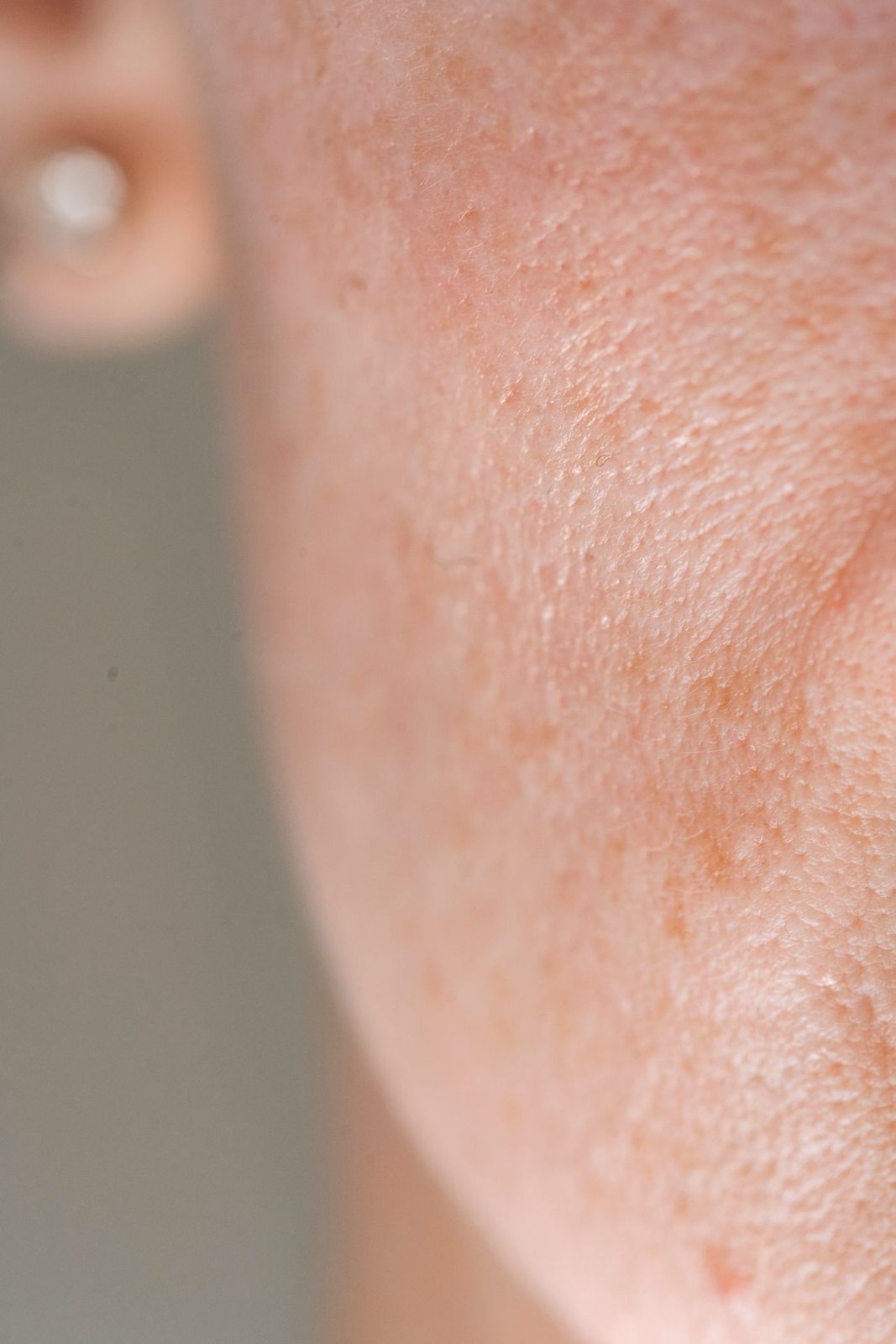 Concerns treated by co2 laser resurfacing in Mississauga