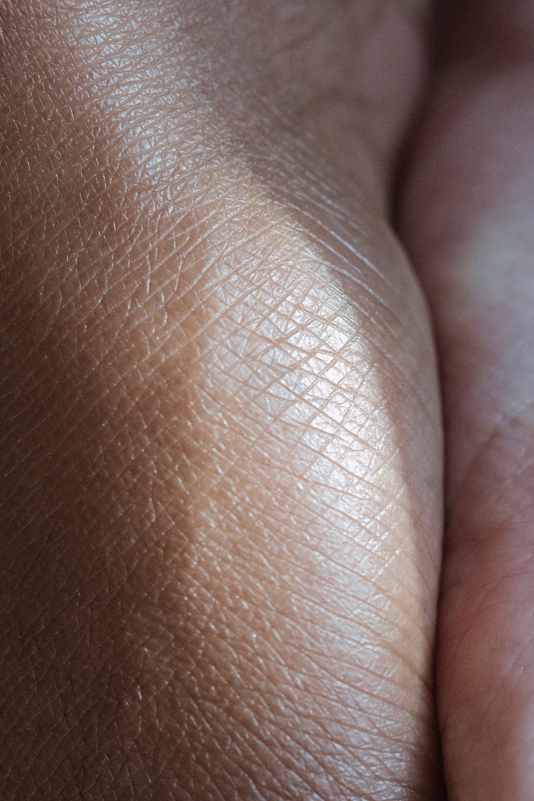 Hyperhidrosis Treatment in Mississauga, step 1: assessment