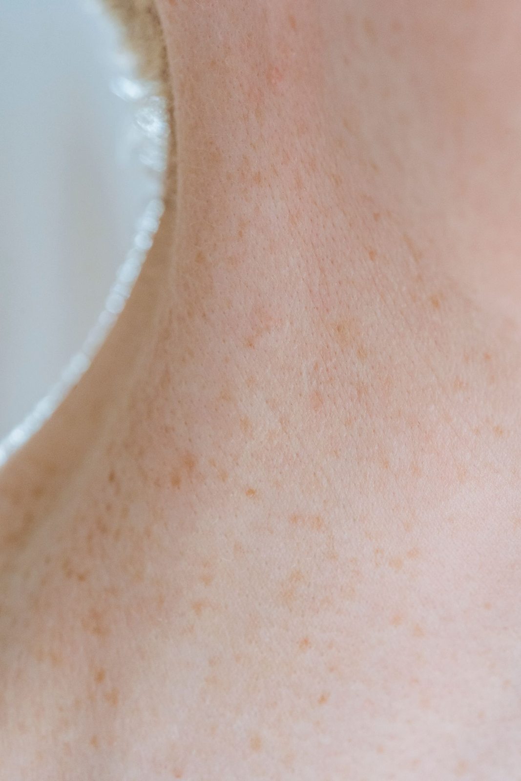 Concerns treated by laser genesis in Mississauga